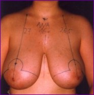 breast reduction before surgery